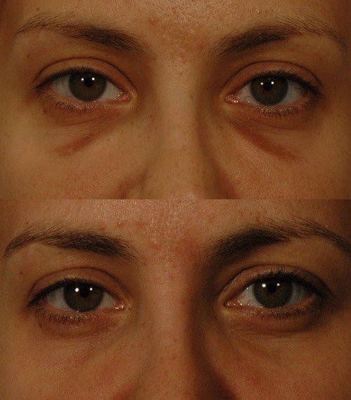 A before and after image of patient with hemosiderin stain under the eyes.photo