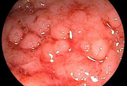 A closed up view of inflamed colon