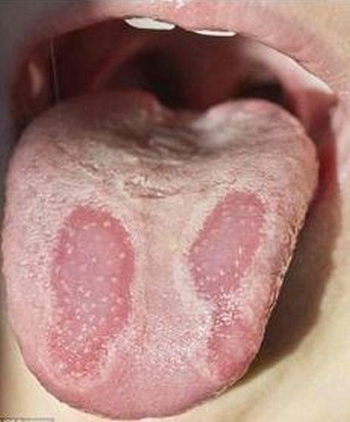 A patient with an itchy tongue with obvious white coating.image