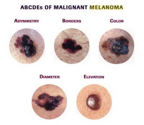ABCDE rule of malignant Melanoma