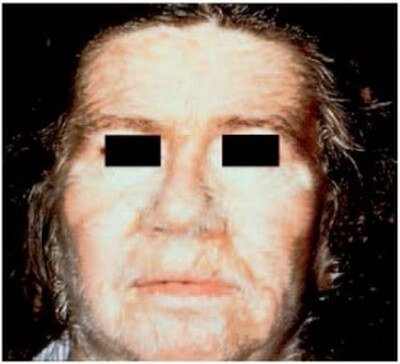 Acquired Generalized Hypertrichosis Lanuginosa