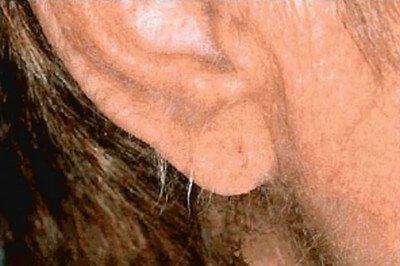 Acquired Generalized Hypertrichosis indicating internal malignancy.