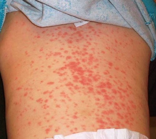 Amoxicillin rash in an infant.picture