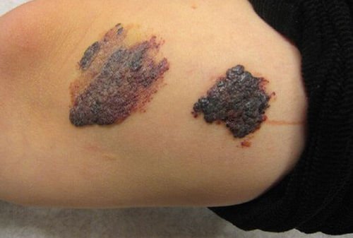 Angiokeratoma that forms in clusters image photo picture