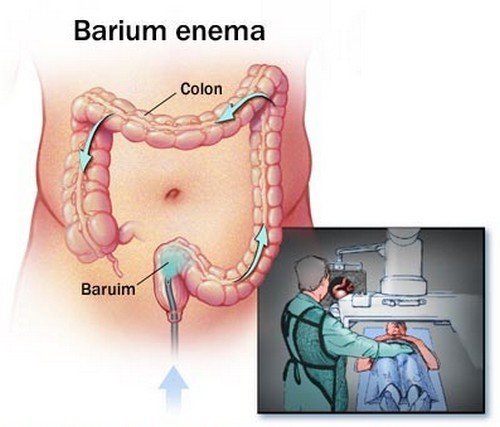 Barium enema, one of the procedures used to detect obstipation.image