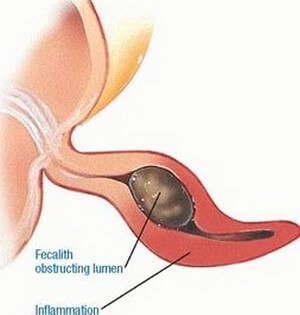 Causes of Appendix Pain