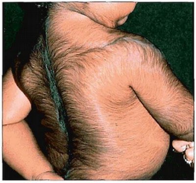 Congenital Hypertrichosis Lanuginosa