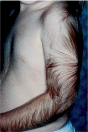 Cyclosporine-Related Hypertrichosis