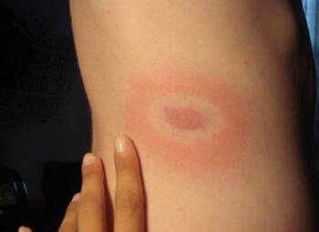 Erythema Migrans picture