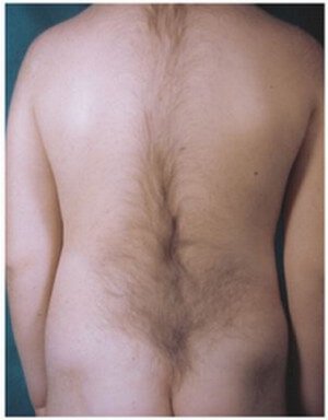 Fawn Tail in Spina Bifida