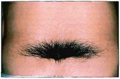 Hypertrichosis over the sacral midline is a sign of spinal dysraphism.