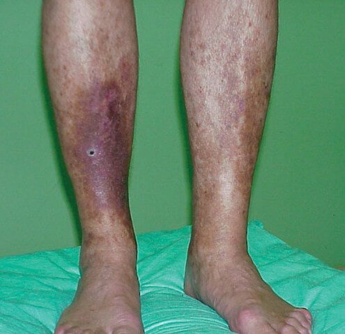 Lipodermatosclerosis due to venous insufficiency image