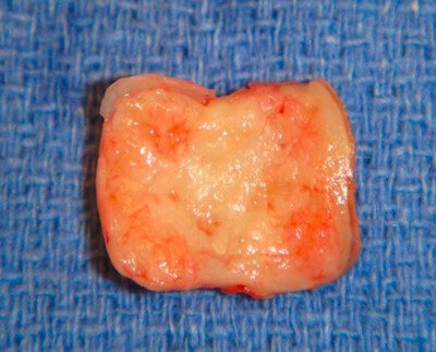 Nail portion which was necessary to remove due to subungual melanoma