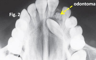 Odontome or Composite Odontoma image