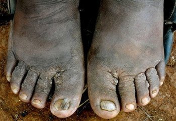 Podoconiosis 1