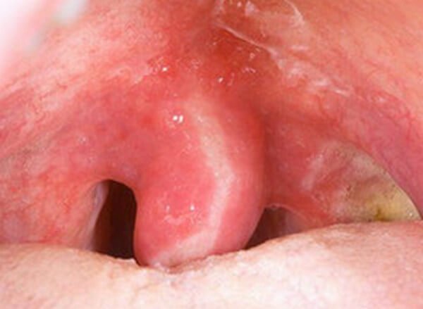 Swollen Uvula