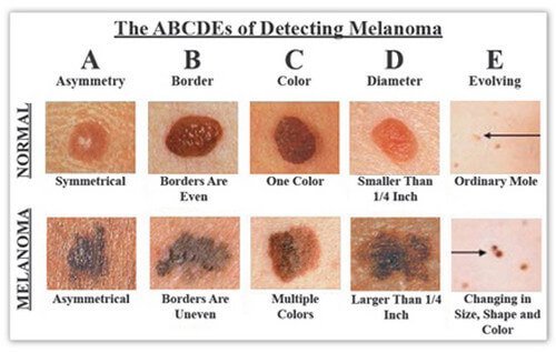 The ABCDEs of Detecting Melanoma