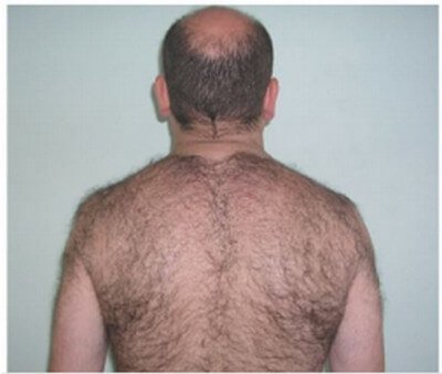 Universal Hypertrichosis in the back of a man