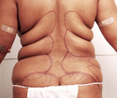 a person who has a lot of love handles, being assessed and prepared for lipolysis treatment.image