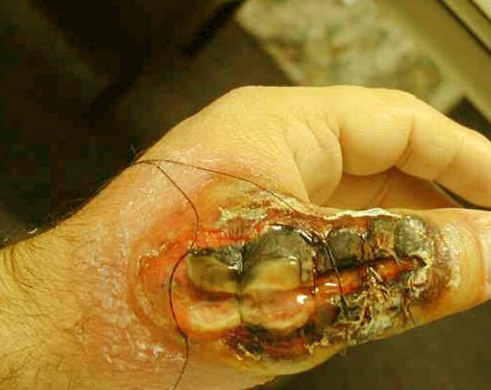 brown recluse spider bite