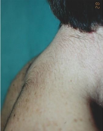 costaleros that have bufaloid neck - hypertrichosis