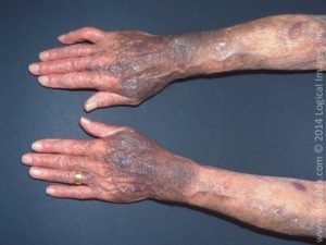 ecchymoses due to steroid-induced purpura