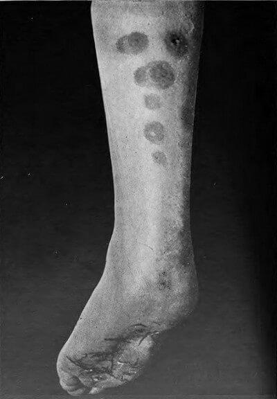 erythema induratum image