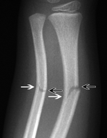 greenstick fracture