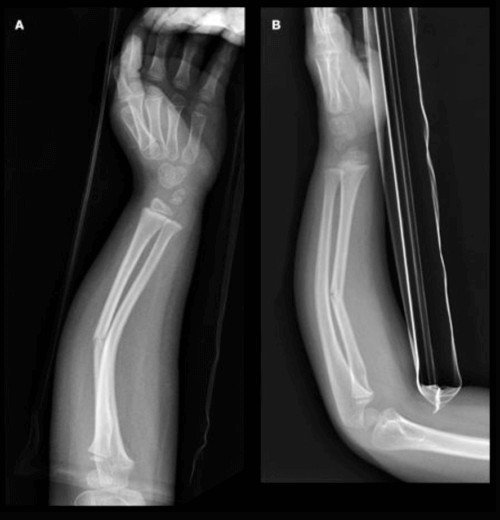 Greenstick Fracture Of Wrist
