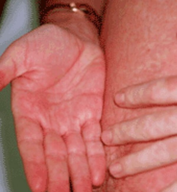 hiv rash picture