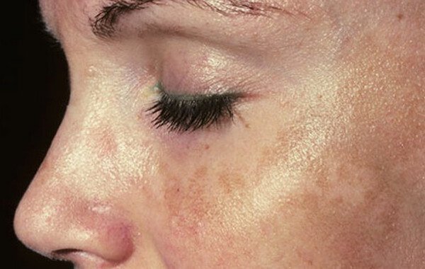 melasma face photos