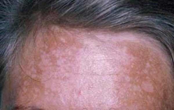 melasma forehead images