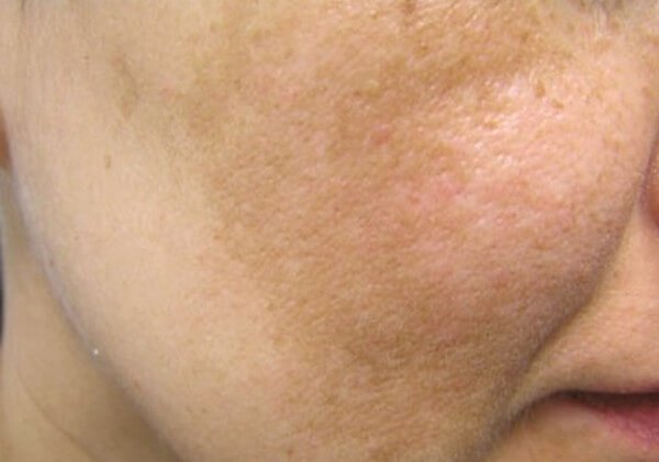 melasma pictures