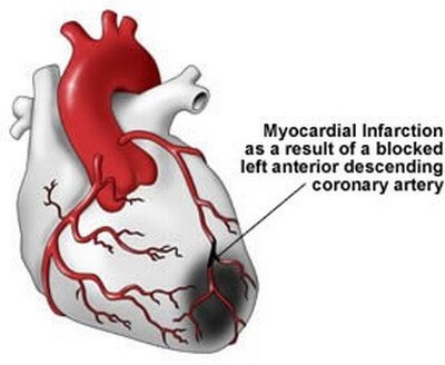 myocardial infarction caused by heart muscle death image