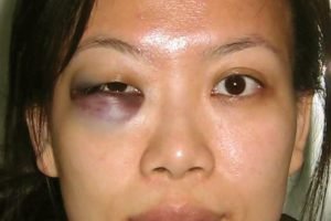 unilateral periorbital ecchymosis